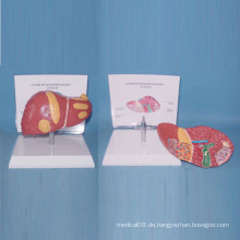 Human Pathological Leber Medizinische Anatomie Modell für die Lehre (R100106)